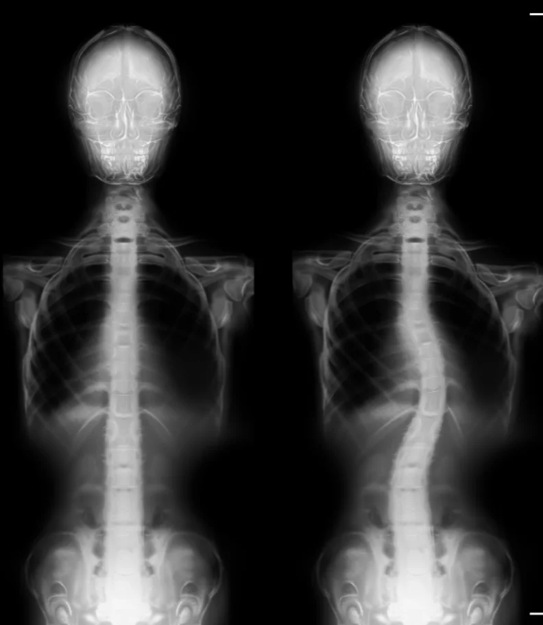 scoliosis Hudson WI